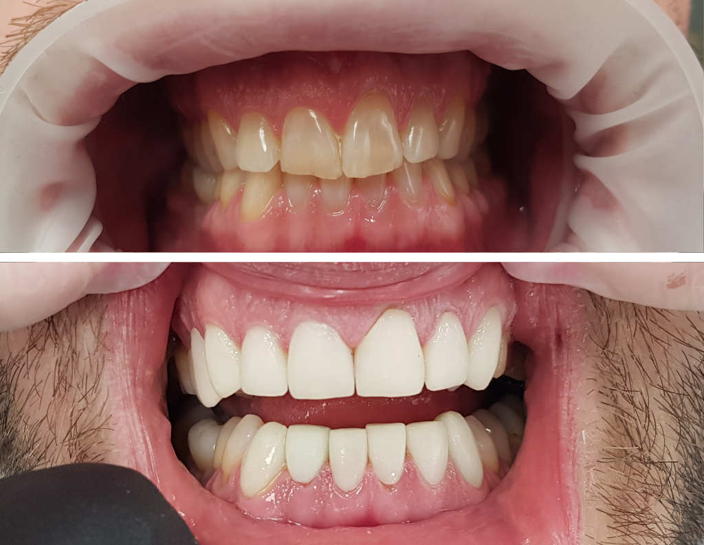 Presskeramik-Veneers