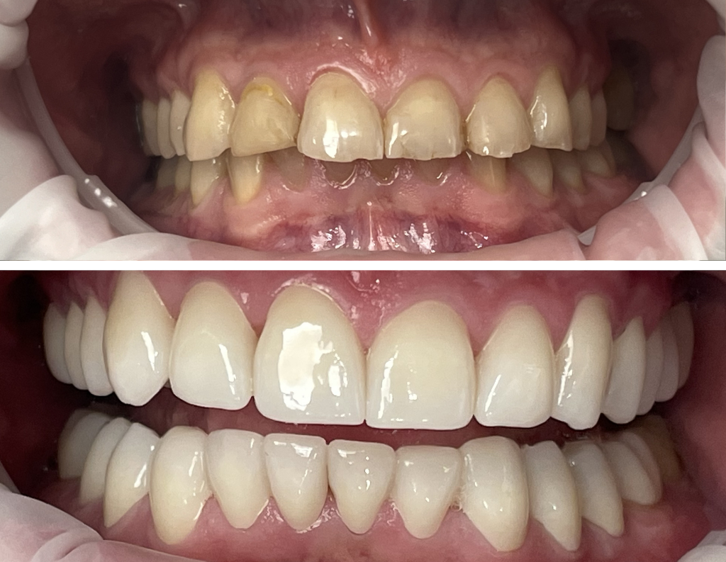 Prettau Zirkon-Kronen und -Brücken