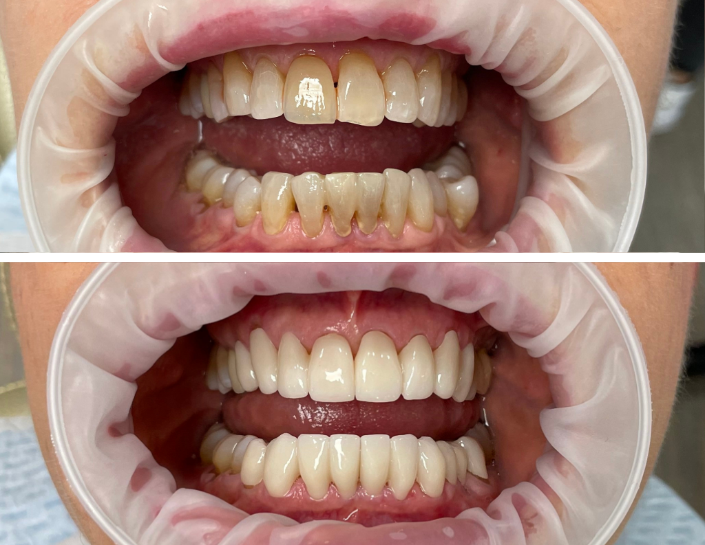 Lächelverjüngung mit kleinen Brücken