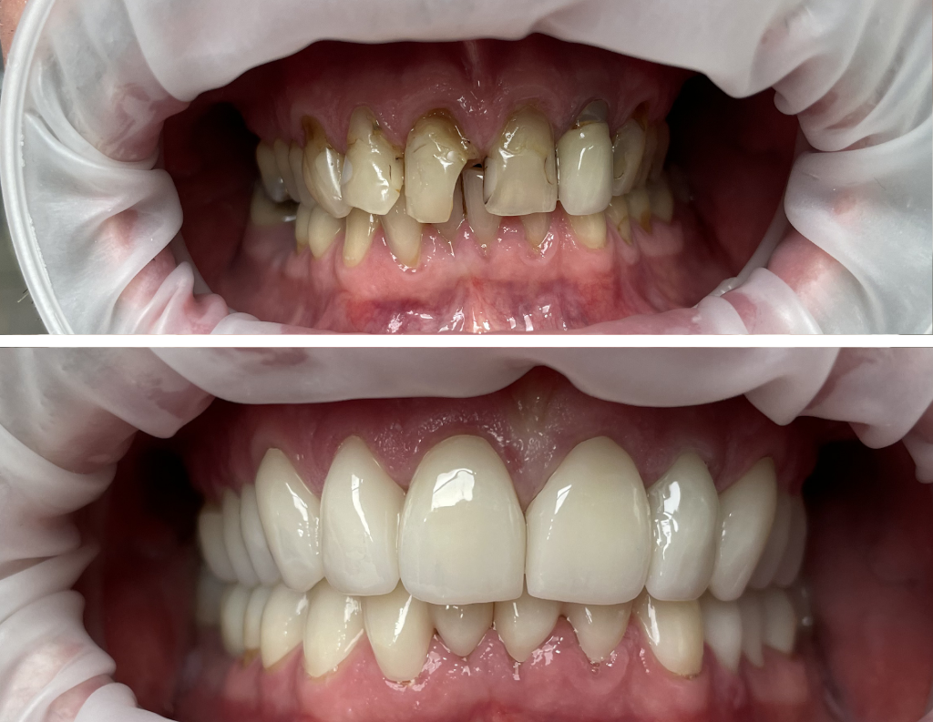 Komplette Lächelrekonstruktion mit Kronen und Brücken – wenn Veränderung Lebensqualität schafft