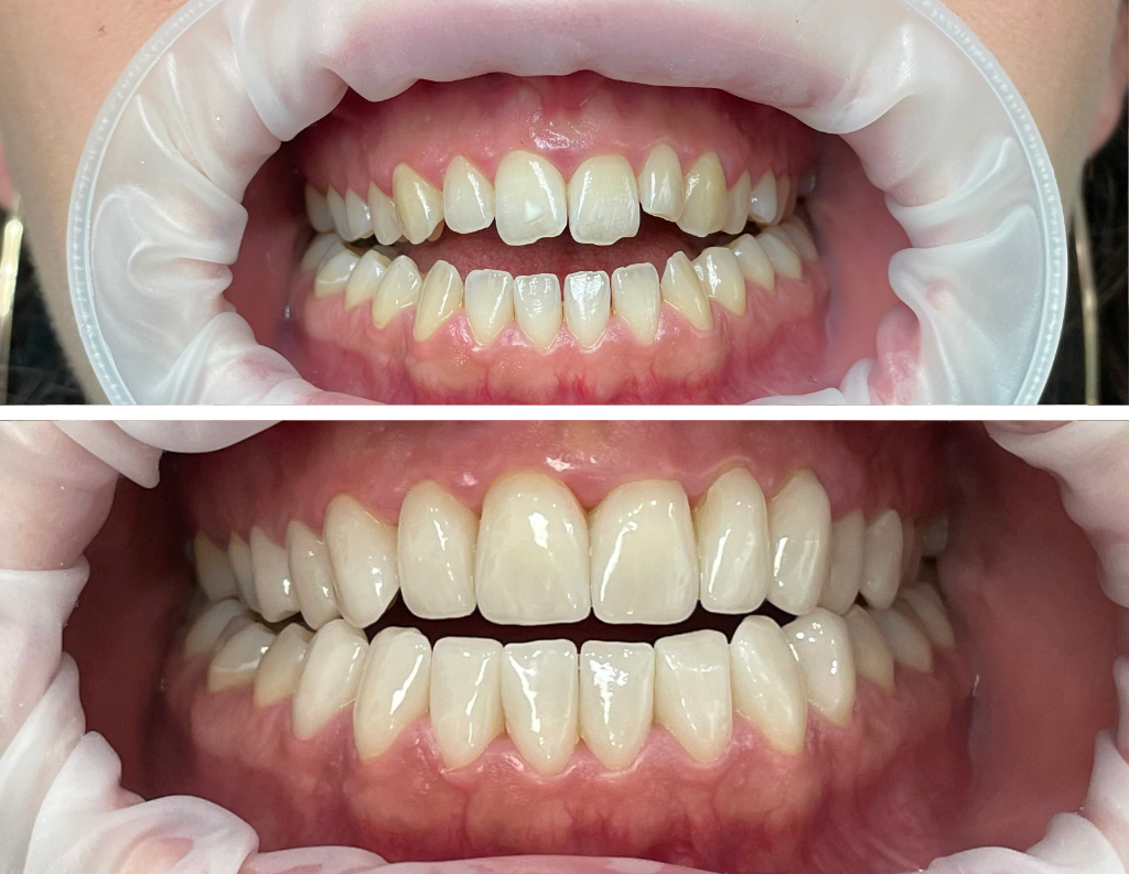 Presskeramik-Veneers als Alternative zur Operation